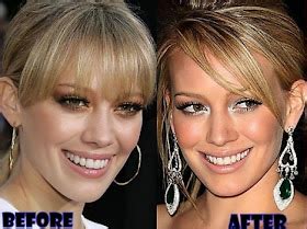 hillary duff nose job|How A